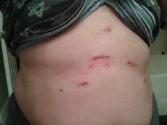 Surgery Scars, 3 days post-op