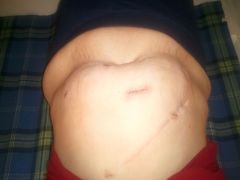 The day after surgery 4/14/12