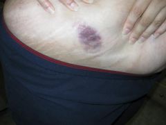 The big black bruise from the shots I got all in one spot that are to thin my blood while I was in the hospital.