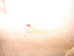 This is the hole where the port is located under the skin. I can actually feel it if I touch it.