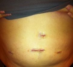 Bloated incisions