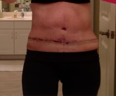 24 hrs after tummy tuck surgery