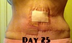 tummy Day 25