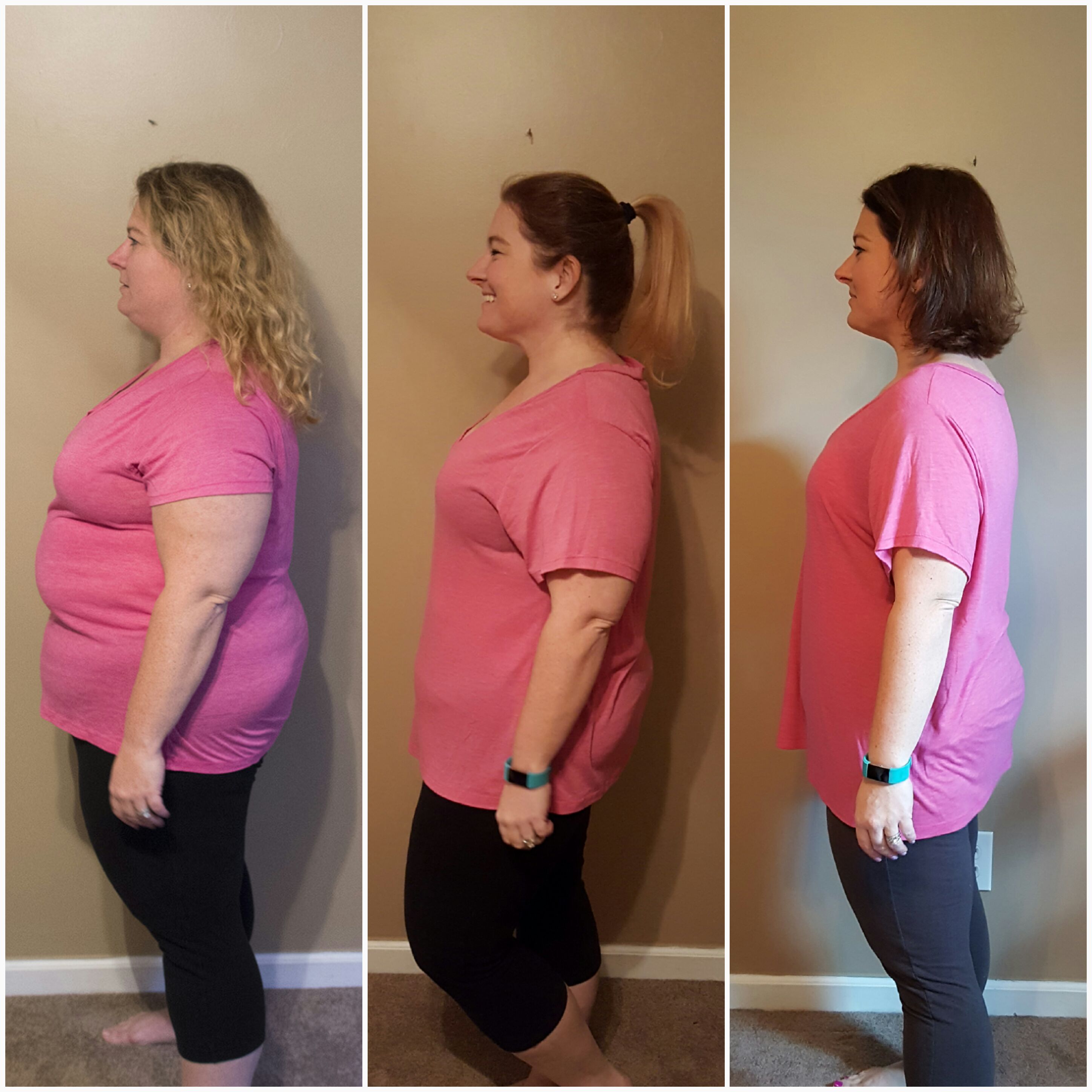 Gastric Sleeve Before And After 6 Months 8832