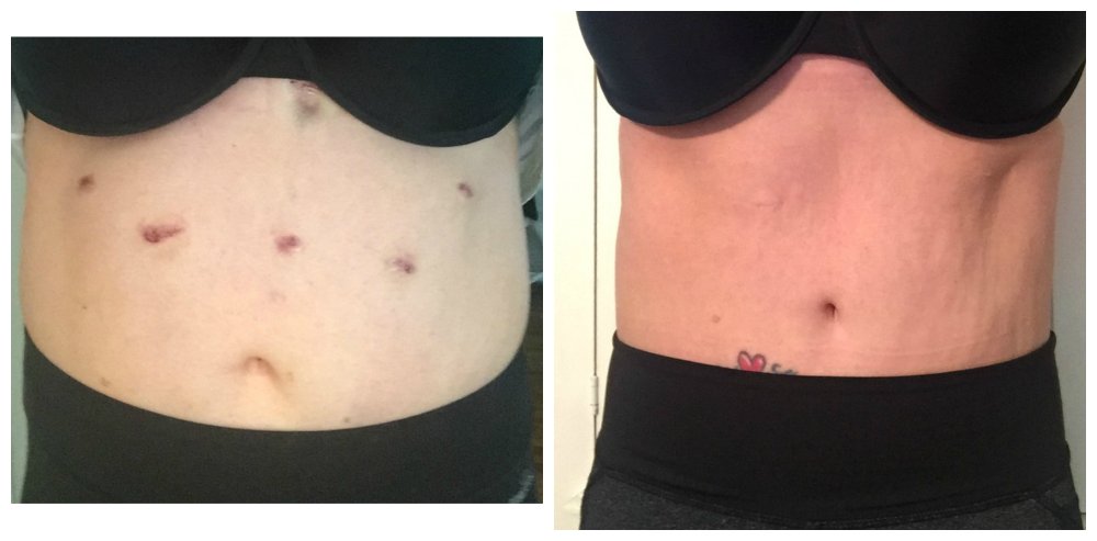 Surgery scars before.after 05.16 - 05.17.jpg