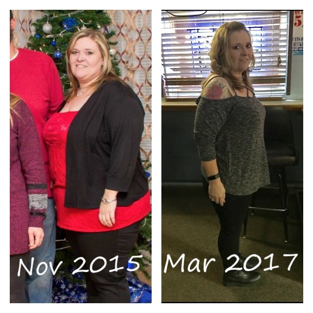 6 Months Post Op Gastric Bypass Bariatricpal