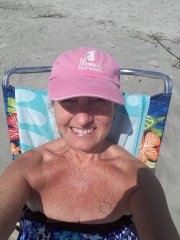 Selfie on the beach 11 months from surgery.