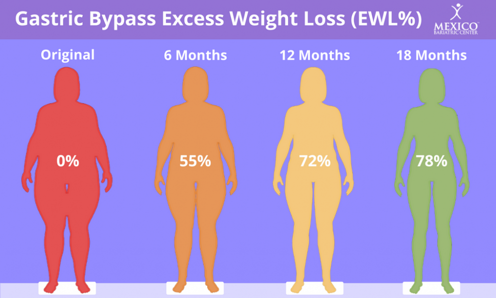 Gastric-Bypass-Expected-Weight-Loss.png