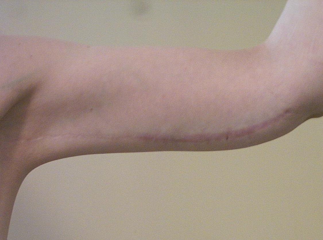 Left Arm Scar 260611.jpg