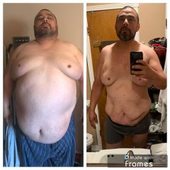 Before and after gastric sleeve