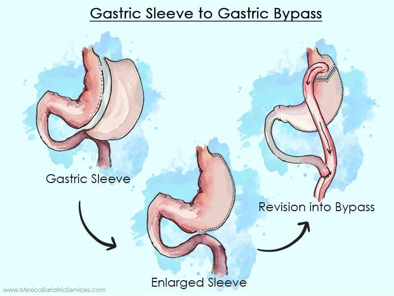 gastric-sleeve-to-gasatric-bypass.jpg