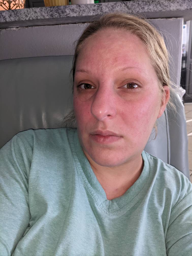 suge Lille bitte anklageren Skin/Red Face 11 days post op - POST-Operation Weight Loss Surgery Q&A -  BariatricPal