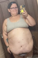 Three months after gastric bypass surgery 