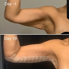 1st month AFTER arm lift
