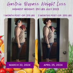 Before and After Gastric Bypass Photos