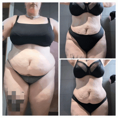 Before and After Gastric Bypass Photos