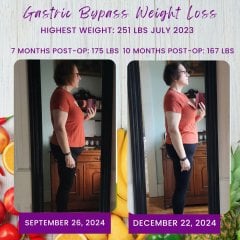 Before and After Gastric Bypass Photos