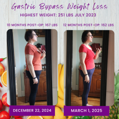 Before and After Gastric Bypass Photos